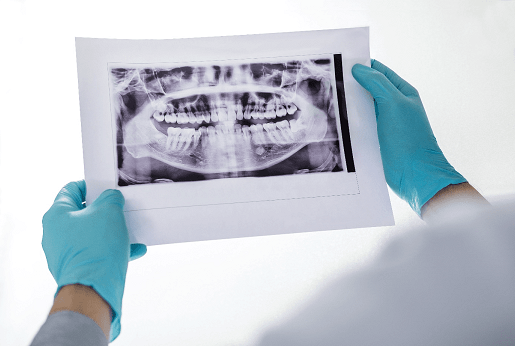 Alles, was man über Karies wissen sollte