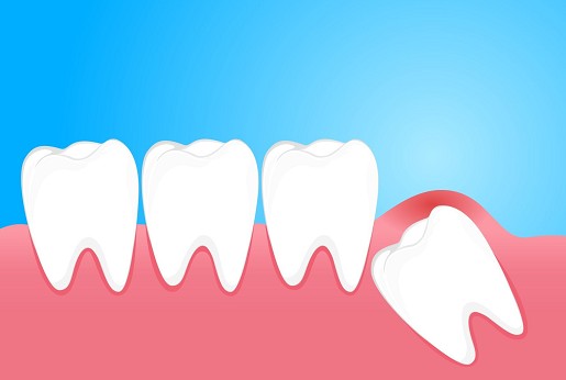Miért kell kihúzni, ami ki sem nőtt? – Bölcsességfog-eltávolítás és fogszabályozás kéz a kézben