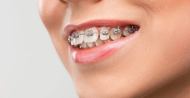 Erwachsenen-Zahnspange